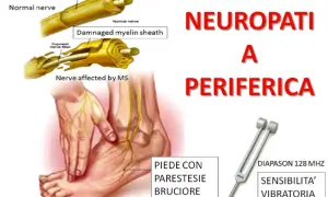 Immagine illustra cosa vuol dire neuropatia periferica: nervi sani e danneggiati, un piede con parestesie e bruciore, e un diapason per testare la sensibilità vibratoria.