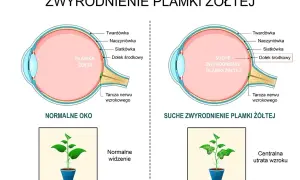 Porównanie normalnego oka z suchym zwyrodnieniem plamki żółtej. Obraz ukazuje, jak odbudowa plamki żółtej jest kluczowa dla normalnego widzenia.