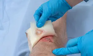 Blaue Handschuhe bedecken eine genähte, offene Wunde am Knie, die mit Gaze abgetupft wird.