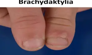 Zbliżenie na palce dłoni z widocznymi krótkimi paznokciami i skórkami, ilustrujące brachydaktylię.