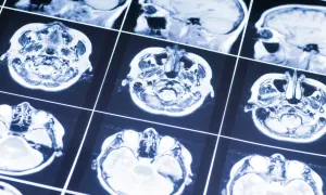 Przekroje mózgu na rezonansie magnetycznym. Obraz może pomóc w diagnostyce oponiak objawy, analizując strukturę tkanki mózgowej.