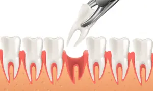Co dentysta wkłada do zęba po usunięciu? Wyjaśniamy proces i zalecenia po zabiegu