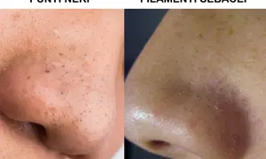Confronto tra punti neri e filamenti sebacei sul naso. Scopri come togliere i punti neri per una pelle più liscia.