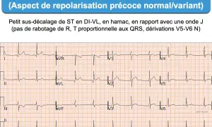 Électrocardiogramme montrant une dérivation VL avec un léger sus-décalage de ST, aspect de repolarisation précoce. L'ECG D2 long révèle une onde J.