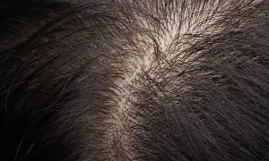 Primo piano del cuoio capelluto con capelli scuri e radi, che sembrano ruvidi al tatto.