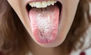 Lingua con patina bianca e rossore, segno di un'infezione da candida che si spera passi da sola.
