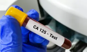 Rękawiczka w niebieskiej rękawiczce trzyma probówkę z krwią z etykietą "CA 125 - Test". To badanie pomaga wykryć pewne schorzenia.
