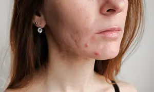 Skóra młodej kobiety z widocznym trądzikiem androgennym na policzkach i podbródku. Widać zaczerwienienia i wypryski.