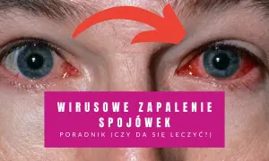 Czerwone, podrażnione oczy z widocznymi naczynkami. Napis informuje o wirusowym zapaleniu spojówek i poradniku leczenia.