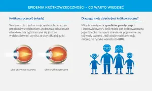 Krótkowzroczność: czy ma plusy? Poznaj wady i metody korekcji
