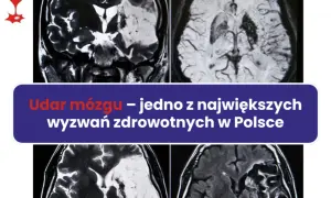 Udar mózgu: Czy umiera się? Kluczowe fakty i nadzieja na życie.