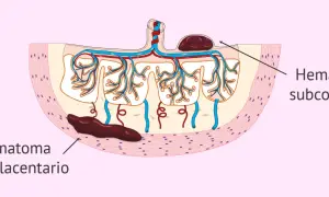 Ilustración de hematoma subcoriónico y retroplacentario, mostrando cómo se expulsa un hematoma en el embarazo.