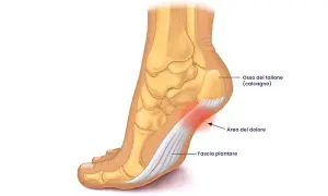 Illustrazione anatomica del piede che evidenzia l'osso del tallone, la fascia plantare e l'area del dolore, utile per capire i tallonite rimedi.