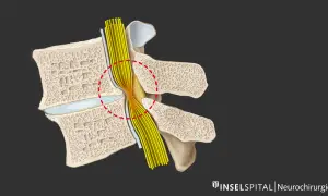 Darstellung einer Spinalkanalstenose, die den Nervenstrang komprimiert. Mögliche Indikation für eine spinalkanalstenose op.