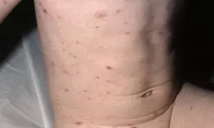Barnets hud täckt av röda prickar, typiska för vattkoppor.