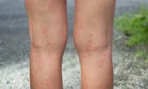 Na nogach widoczne są liczne, czerwone bąble na skórze, przypominające pokrzywkę.