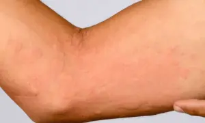 Czy brzoza uczula? Objawy alergii i jak ich unikać w sezonie pylenia