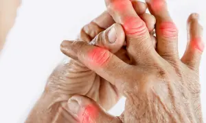 Schmerzende Fingergelenke, die auf Gicht hindeuten. Naturheilkunde kann Linderung bringen.