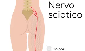 Illustrazione del nervo sciatico e del dolore al polpaccio. Rimedi per la sciatica.