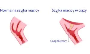 Czy krótka szyjka macicy ułatwia poród? Fakty, zagrożenia i porady dla kobiet w ciąży