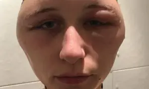 Alergia na farby do włosów objawy - jak uniknąć niebezpiecznych reakcji