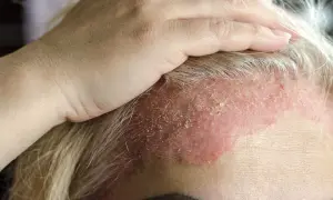 Dłoń dotyka czoła z widocznym zaczerwienieniem i łuszczącą się skórą głowy, co może wskazywać na problem dermatologiczny.