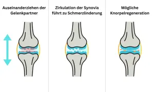 Illustration zeigt Knie-Distraktion: Gelenkpartner ziehen auseinander, Synovia-Zirkulation lindert Schmerz, Knorpel kann sich regenerieren.