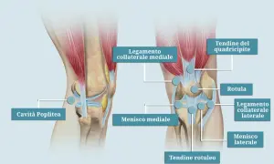 Illustrazione anatomica del ginocchio che evidenzia i legamenti ginocchio infiammati, menischi, rotula e tendini.