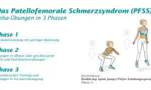 Reha-Übungen in 3 Phasen für das Patellofemorale Schmerzsyndrom (PFSS). Illustration zeigt eine Frau bei Kniebeugen und Sprüngen.