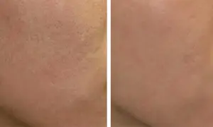 Peeling węglowy co daje? Efekty, korzyści i przeciwwskazania dla zdrowej skóry