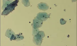 Cellules épithéliales et quelques bactéries, possiblement liées à la gardnerella transmission par l'homme.