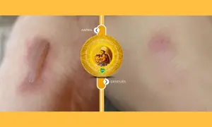 Antes y después de usar la grasa de shea: una cicatriz mejora visiblemente.