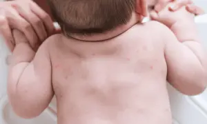Czerwone kropki na plecach niemowlaka, widoczne potówki.