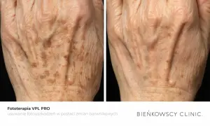 Dłoń przed i po fototerapii. Zmniejszona widoczność przebarwień spowodowanych nadmiarem melaniny.