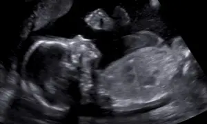 Ultraljudsbild visar två foster. Tidiga symptom på gravid med tvillingar kan vara mer uttalade.