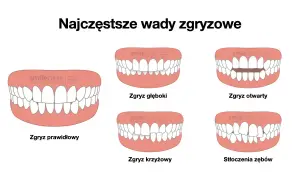 Ilustracja pokazuje różne wady zgryzu: zgryz głęboki, otwarty, krzyżowy i stłoczenia zębów, obok prawidłowego zgryzu.