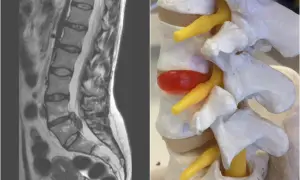 MRI kręgosłupa lędźwiowego obok modelu anatomicznego z przepukliną dysku, która uciska nerw. Worek oponowy jest widoczny na obu obrazach.