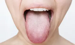 Lingua arrossata e con papille evidenti, possibile segno di candidosi orale.