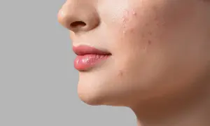 Primo piano del viso di una donna con imperfezioni. La pelle beneficia di niacinamide e acido glicolico per un aspetto più uniforme.