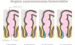 Ilustracja przedstawia stopnie zaawansowania hemoroidów, od I do IV. Różne stopnie mogą mieć różne przyczyny.