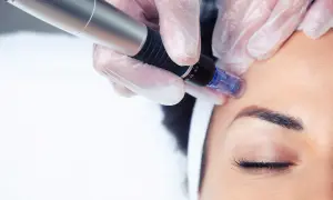 Profesjonalne szkolenia beauty: zabieg mezoterapii mikroigłowej na twarz.