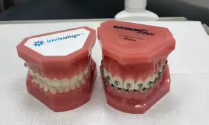 Modele szczęk prezentujące tradycyjny aparat ortodontyczny i dyskretny aparat invisalign.