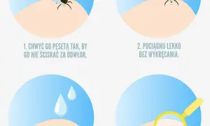 Co zrobić po wyciągnięciu kleszcza? Kluczowe kroki, aby uniknąć problemów