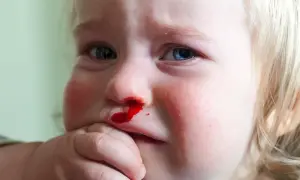 Czemu dziecku leci krew z nosa? Poznaj przyczyny i pomocne rady