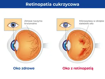 Porównanie oka zdrowego z naczyniami krwionośnymi siatkówki i oka z retinopatią cukrzycową, gdzie widoczne są mikrowylewy.