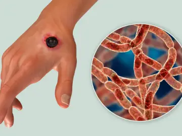 Dłoń z czarną martwicą, objawem skórnej postaci wąglika, obok powiększony obraz bakterii Bacillus anthracis.