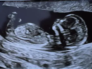 USG płodu, w którym tygodniu widac plec. Dziecko rozwija się, widać jego profil i kręgosłup.