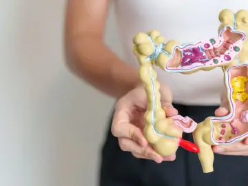 Model jelita z widocznymi zmianami, symbolizujący problemy z jelitem drażliwym.