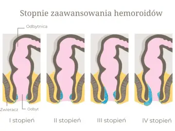 Ilustracja przedstawia stopnie zaawansowania hemoroidów, od I do IV. Różne stopnie mogą mieć różne przyczyny.