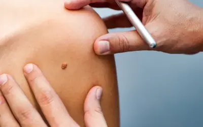 Examen d'un grain de beauté sur l'épaule, un médecin utilise un stylo pour le marquer.